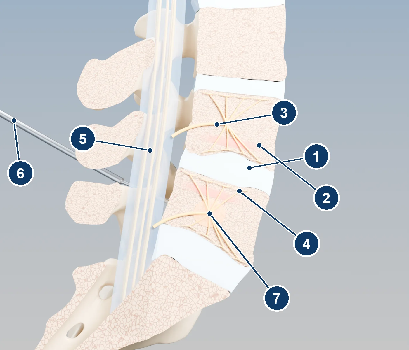 Side-view 3D cutaway of two lower-back vertebrae showing the basivertebral nerve branching inside each vertebra, inflamed endplates, and a probe entering through the pedicle