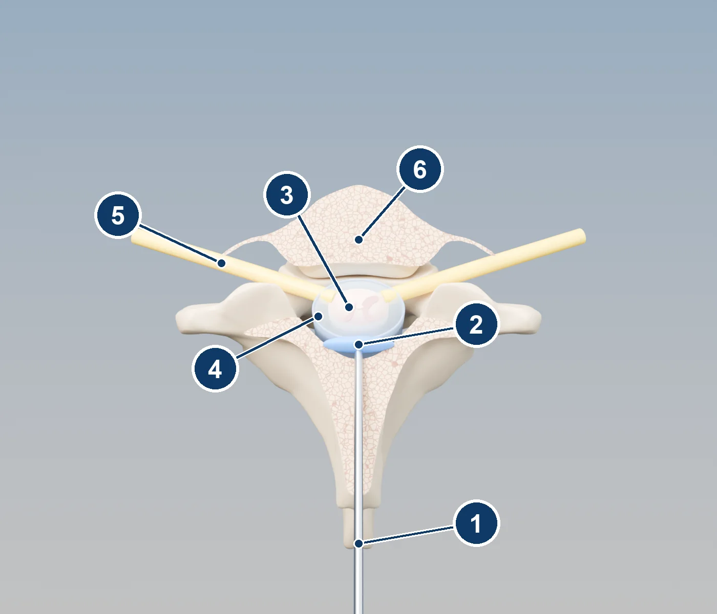 3D top-down cross-section of a neck vertebra showing the spinal cord, its covering, nerve roots, and a needle from the back with a thin layer of medicine behind the covering