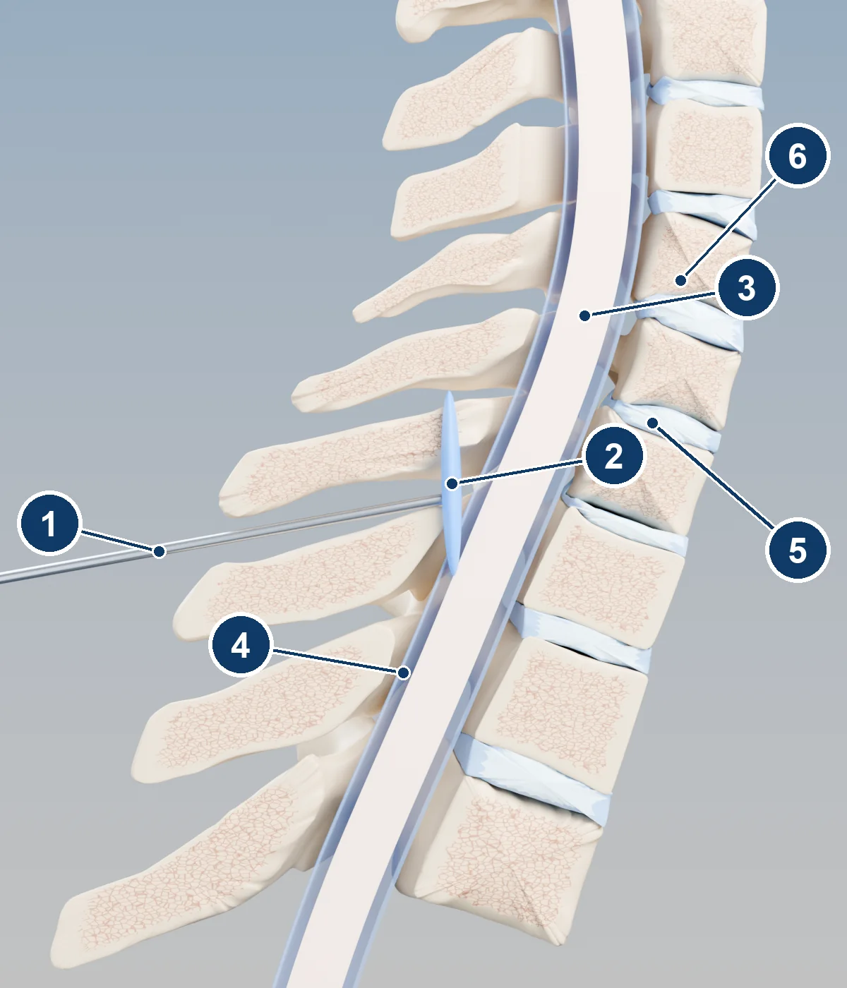 3D side-view cutaway of the lower neck and upper back spine showing a needle between the vertebrae at the back and blue medicine in the epidural space behind the spinal cord
