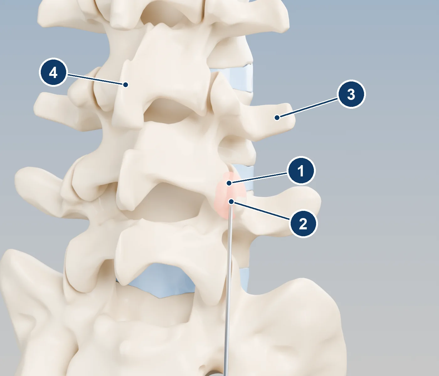 3D view of the lower spine from behind and to the side, showing a thin needle entering an inflamed facet joint between two vertebrae