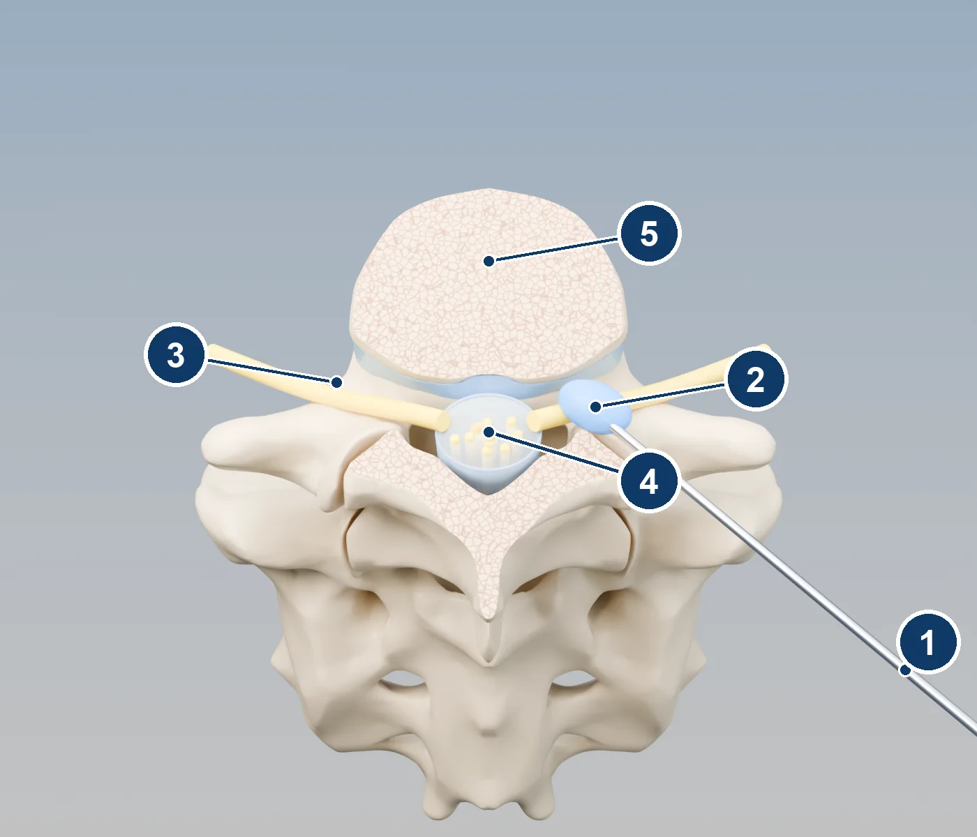 3D top-down cross-section of a lumbar vertebra showing a needle approaching from the side and medicine around the exiting nerve root