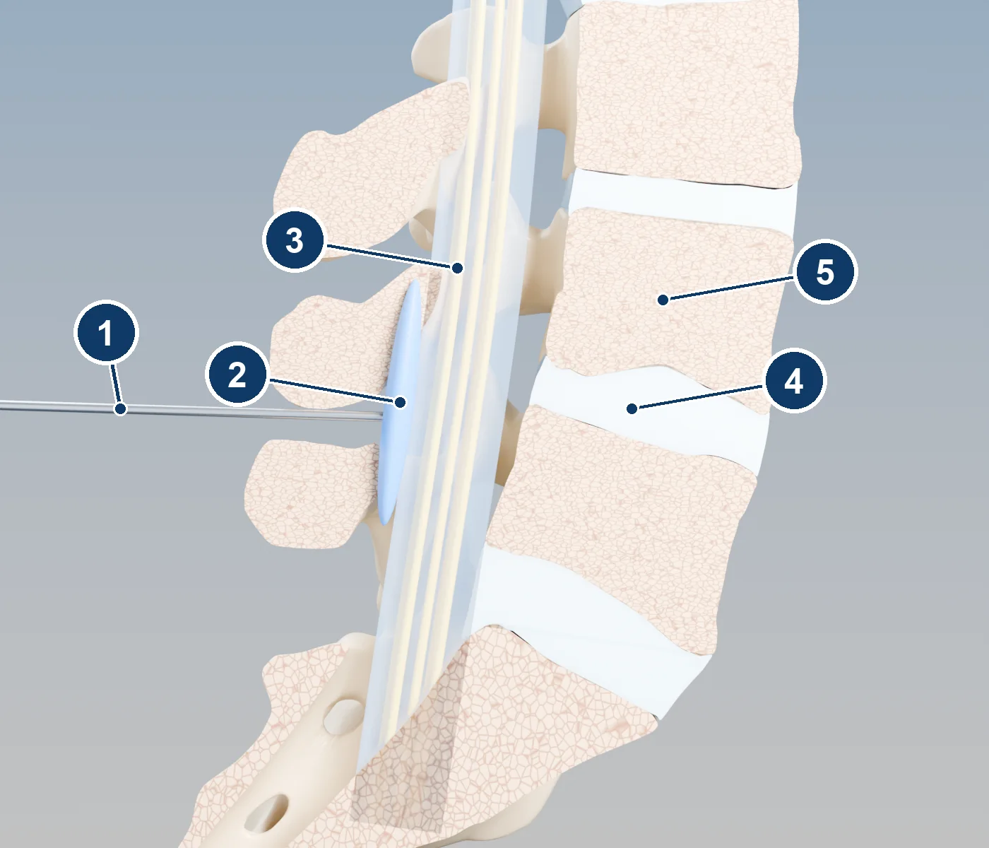 3D side-view cutaway of the lower lumbar spine showing a needle from the back reaching the epidural space, with blue medicine spreading behind the dural sac