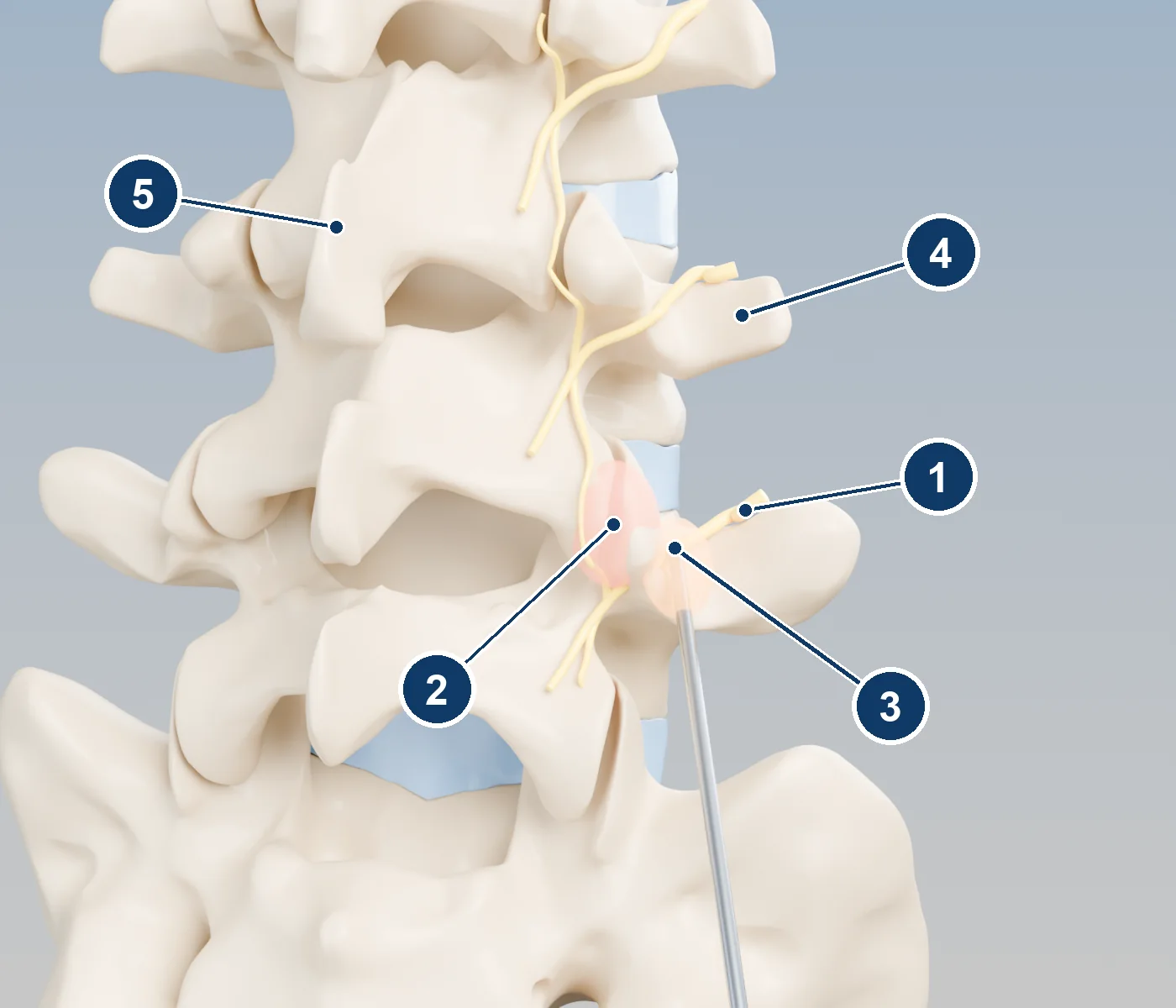 3D view of the lower spine from behind and to the side, showing the medial branch nerves curving over the bone to the facet joints, and a radiofrequency probe heating one nerve