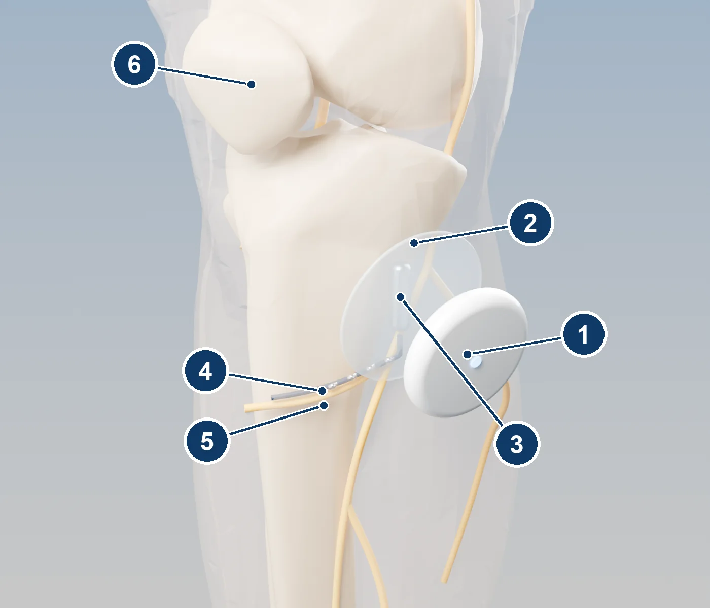 3D view of the knee through translucent skin showing a thin lead beside a small nerve below the kneecap, a tiny implanted receiver, and a wearable disc lifted off its adhesive clip