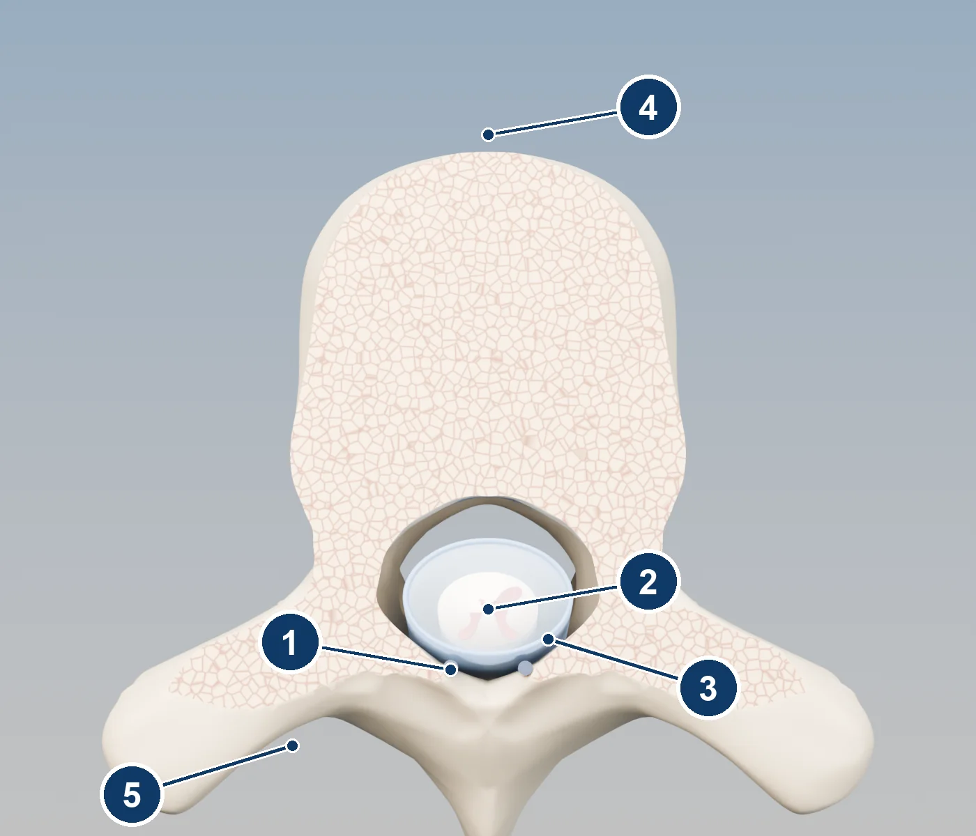 Top-down 3D cross-section of a vertebra showing the spinal cord, its covering, and two leads just behind it in the epidural space