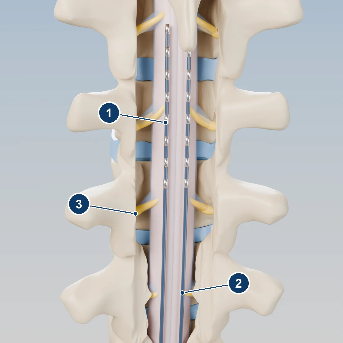3D view from behind of the mid-back spine with part of the bony arch removed, showing two stimulator leads lying over the spinal cord