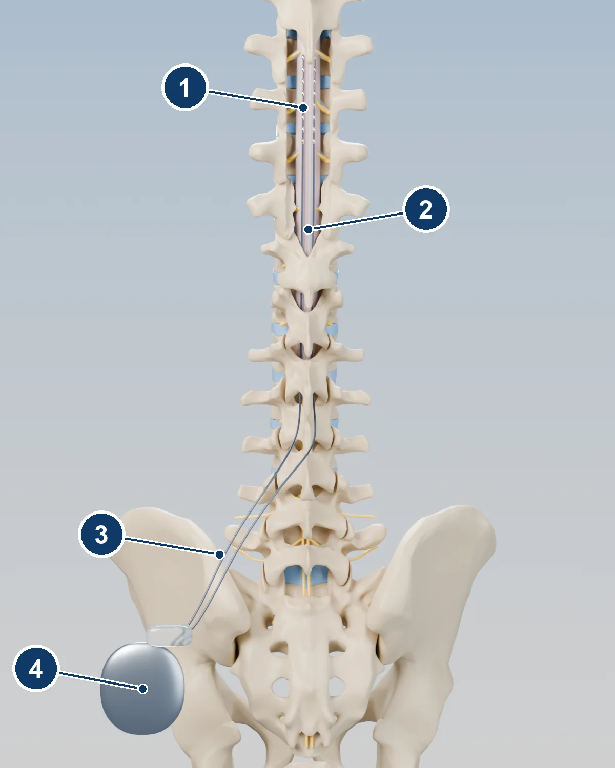 3D view of the spine and pelvis from behind showing leads tunnelled under the skin to an implanted pulse generator in the upper buttock