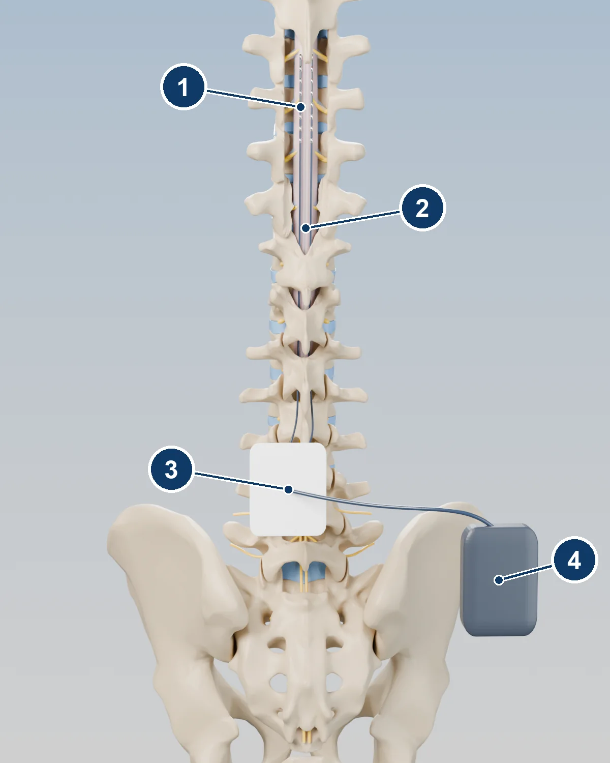 3D view of the spine and pelvis from behind showing temporary trial leads exiting the skin under a dressing and connected to an external stimulator