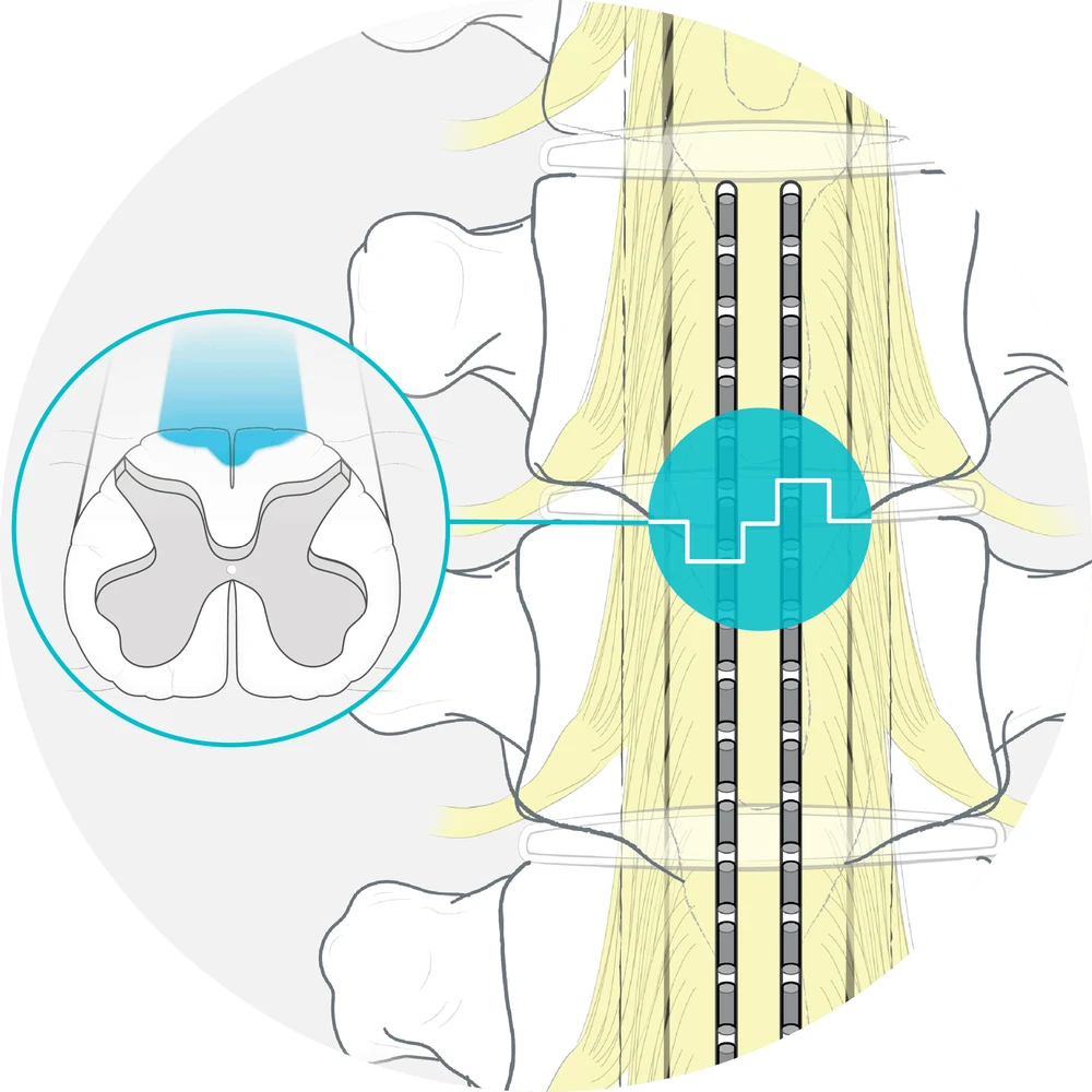 Drawing of two stimulator leads lying behind the spinal cord, with a circle marking the active contacts and an inset cross-section showing stimulation reaching the back of the spinal cord