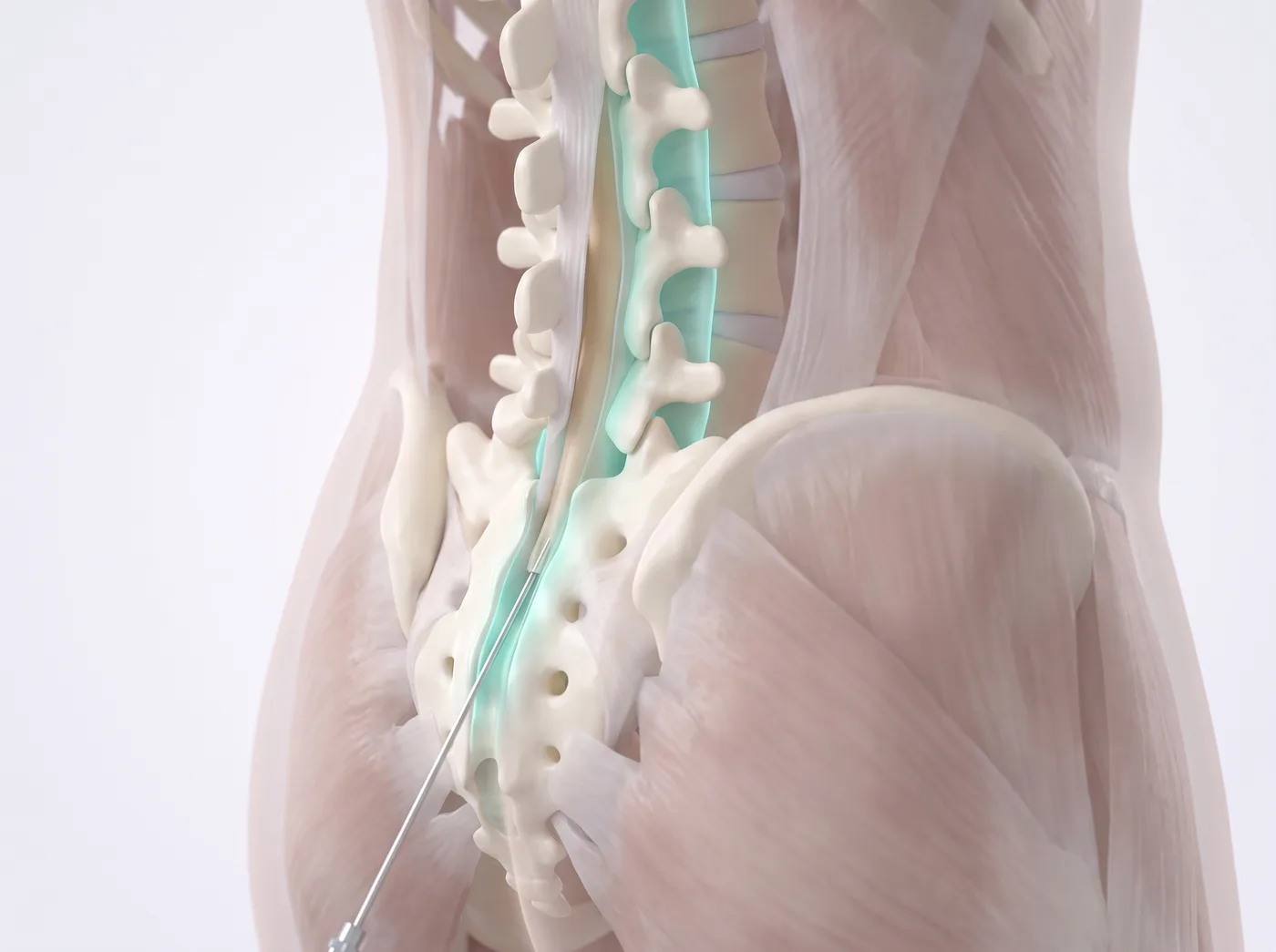 The procedure — medical illustration