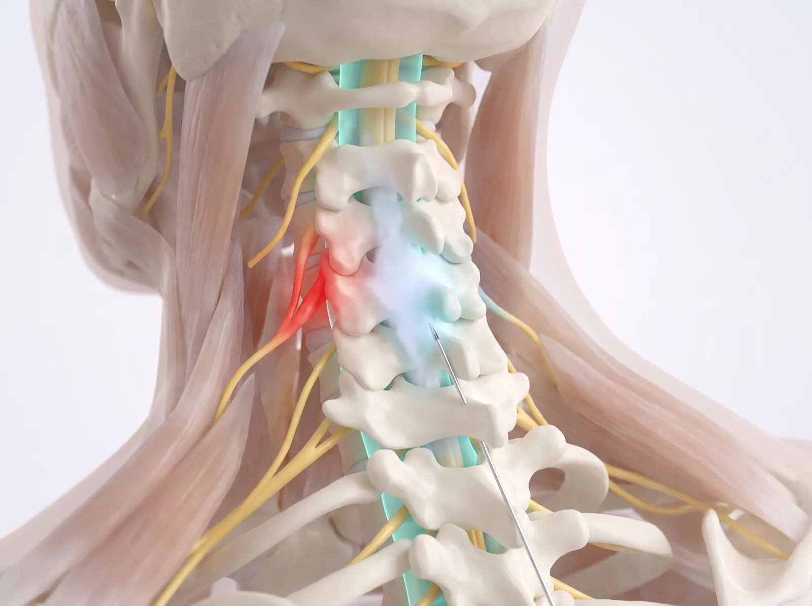 Relief delivered — medical illustration