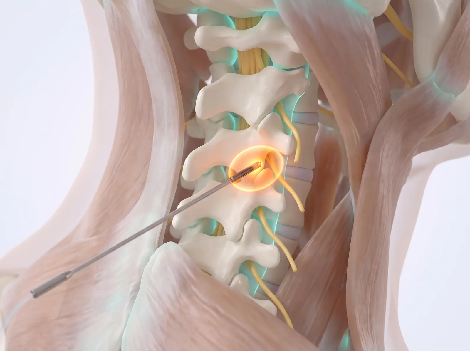 Radiofrequency ablation — medical illustration