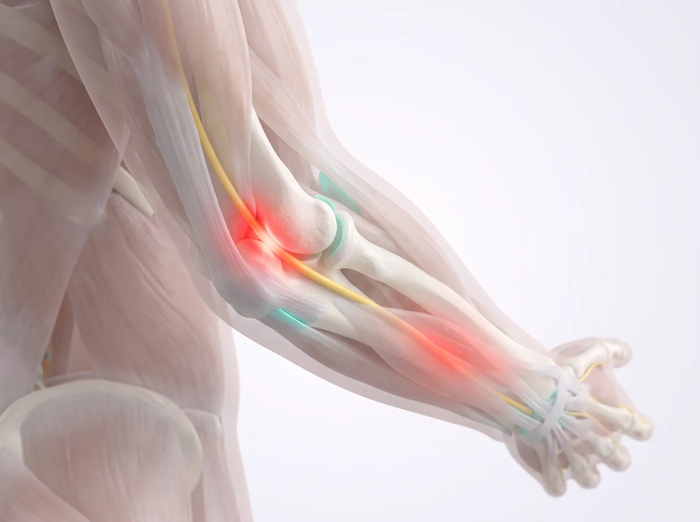 Cubital Tunnel Syndrome illustration