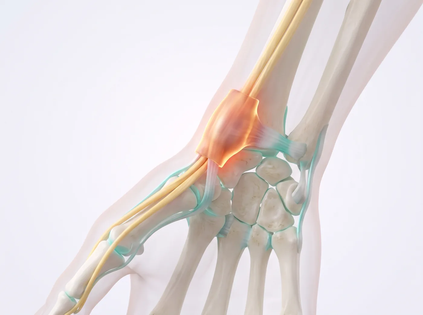 De Quervain's Tenosynovitis illustration