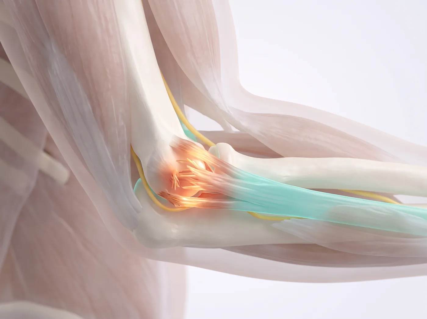 Tennis Elbow (Lateral Epicondylalgia) illustration