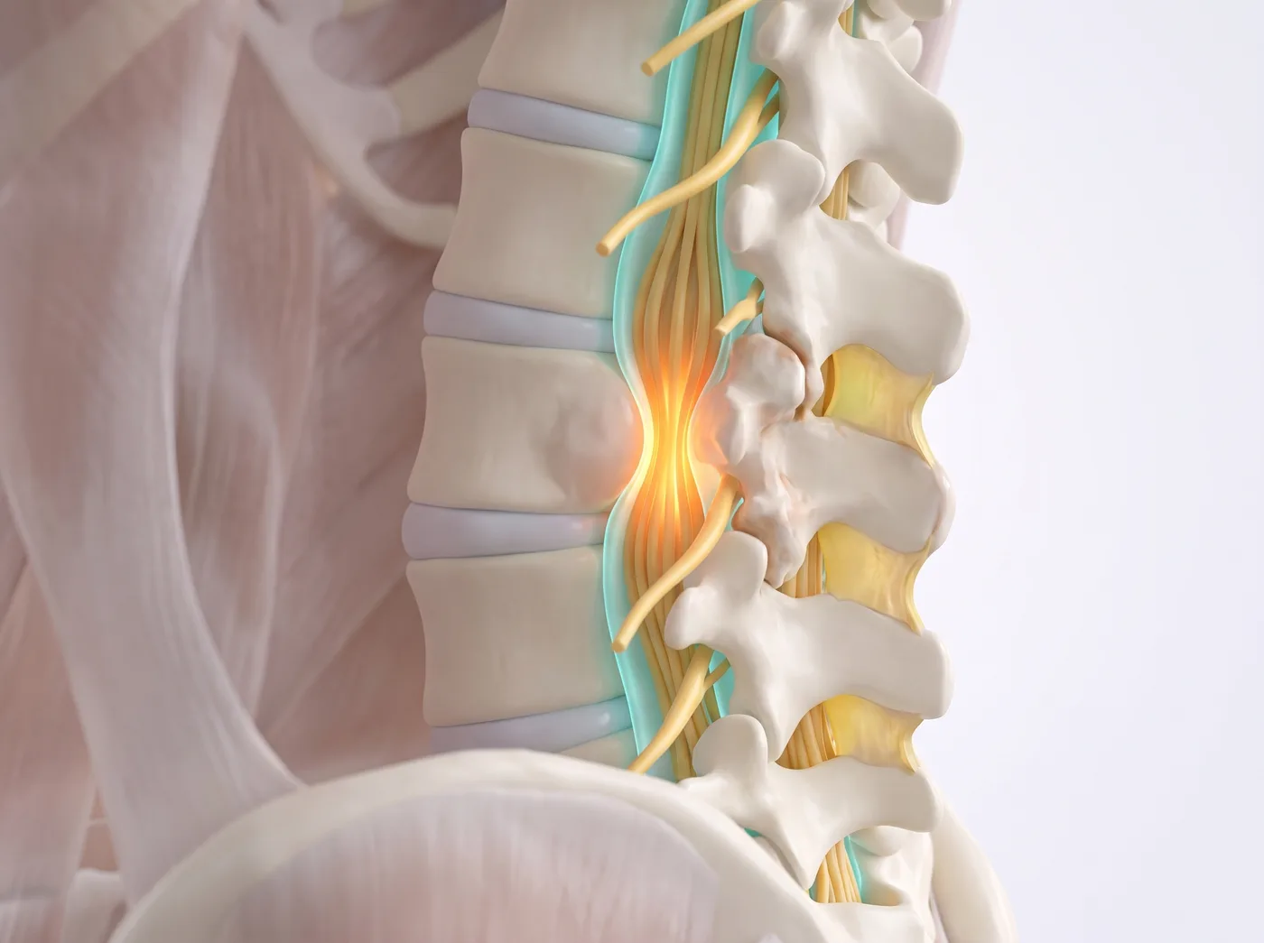 Lumbar Spinal Stenosis illustration