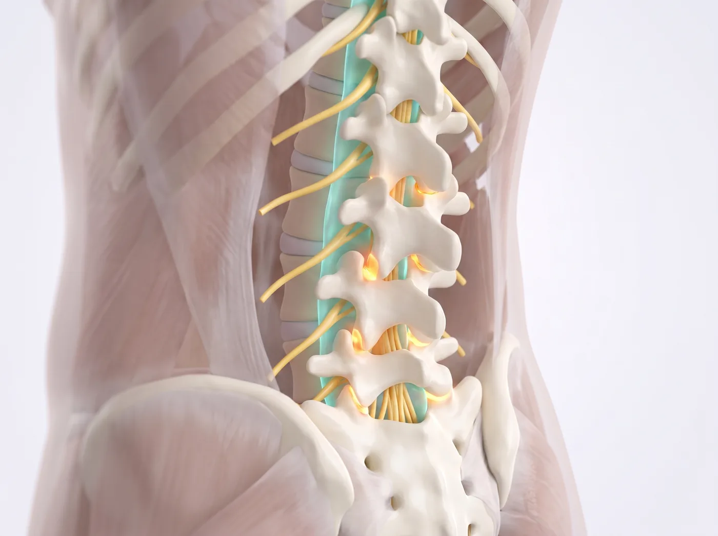Spondylolisthesis illustration