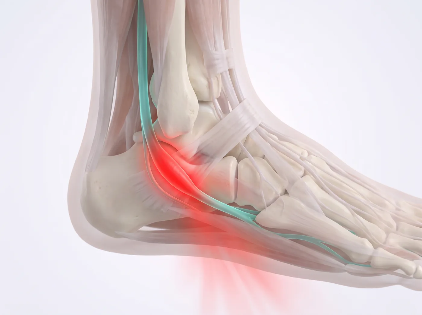 Tarsal Tunnel Syndrome illustration