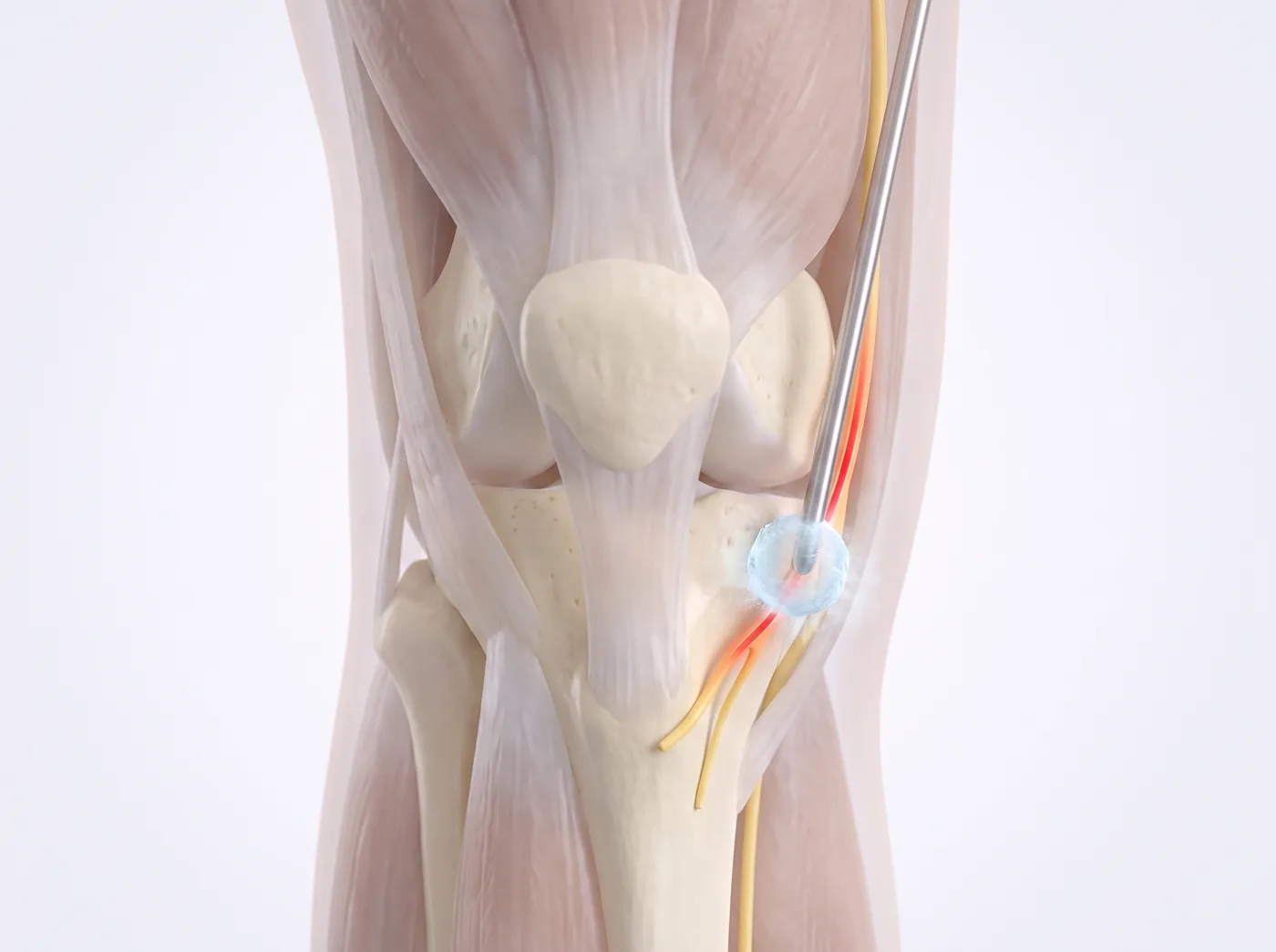 The freeze — medical illustration