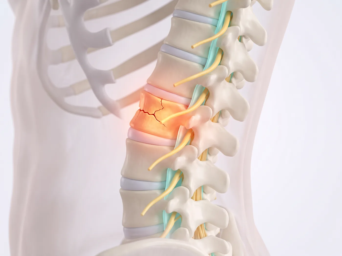 The fracture — medical illustration