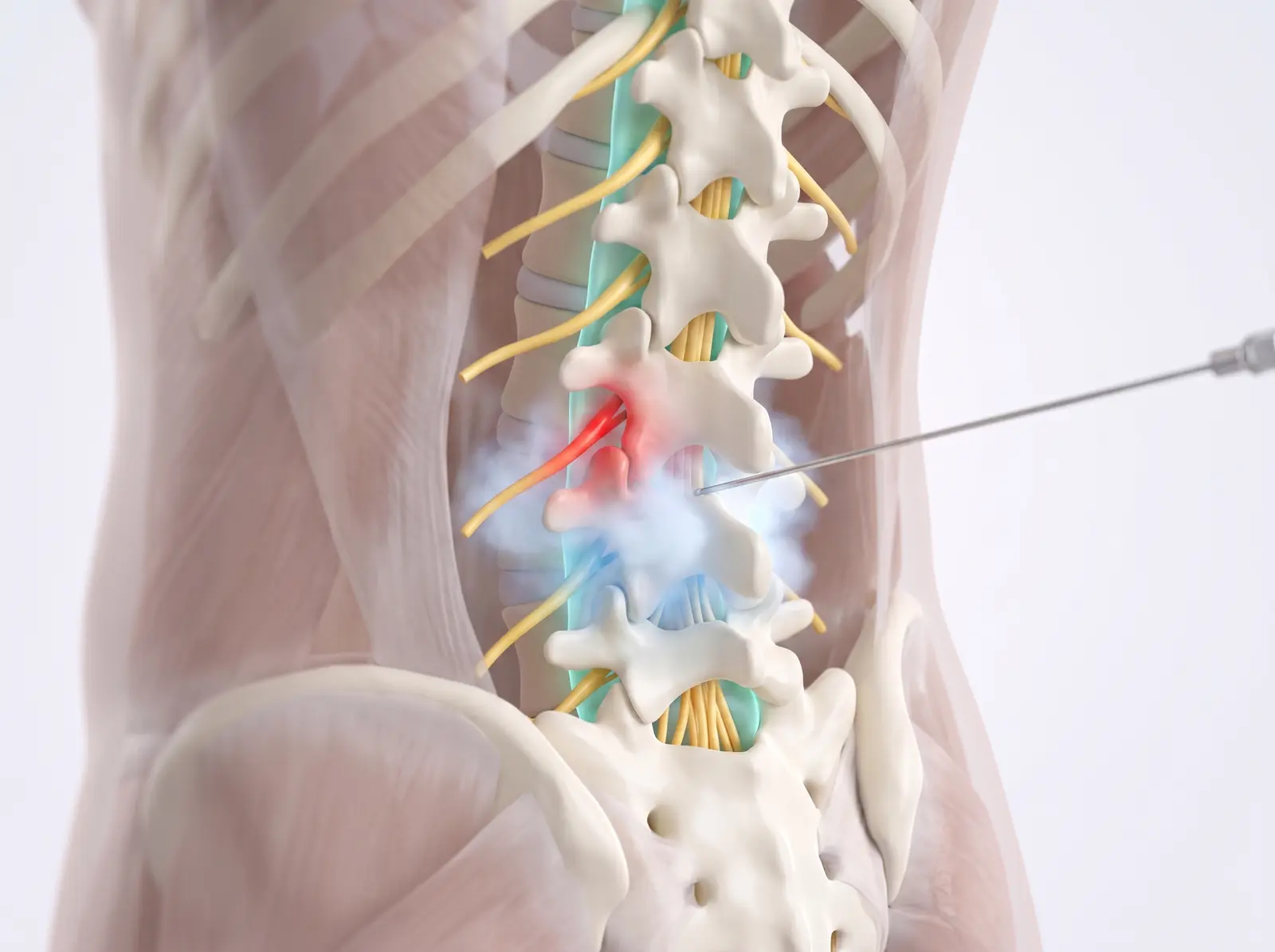 Relief delivered — medical illustration