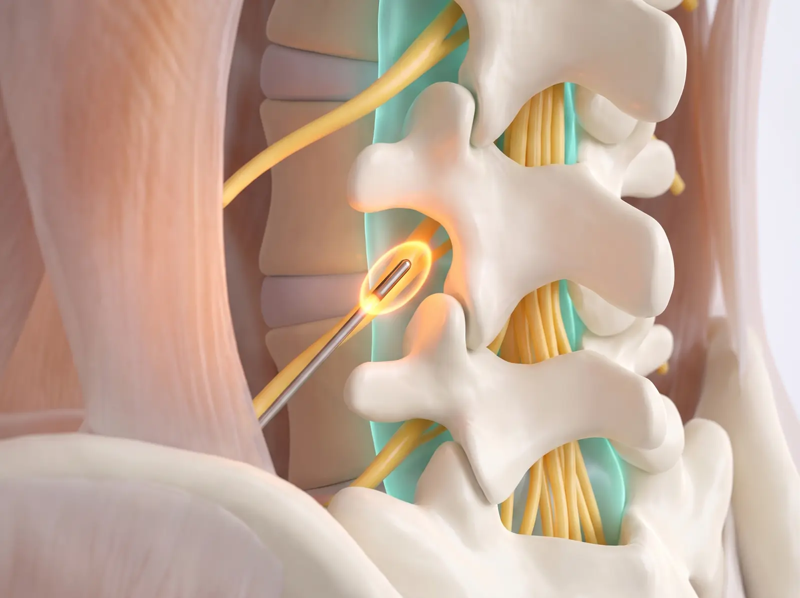 Radiofrequency ablation — medical illustration