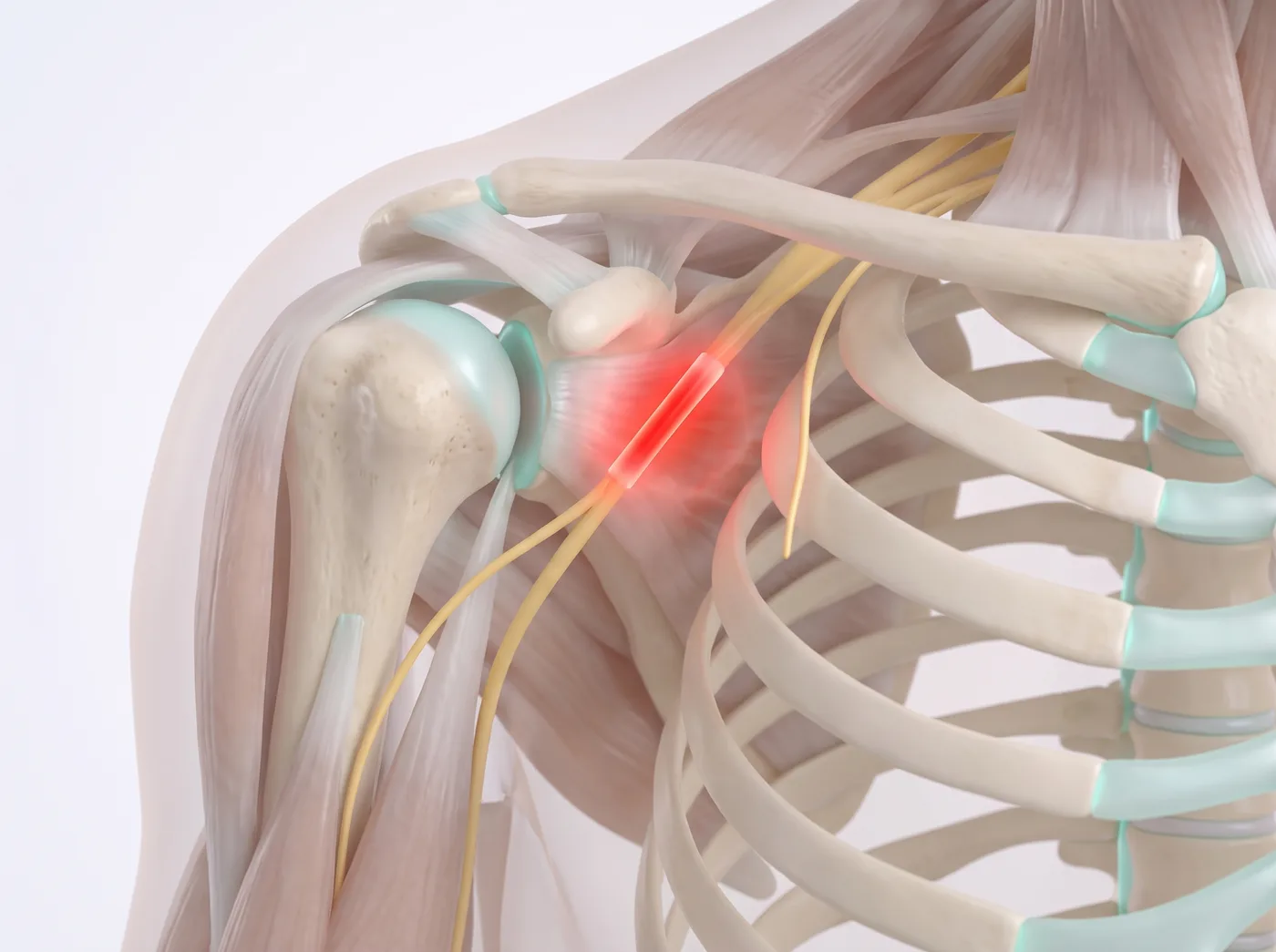 One painful nerve — medical illustration