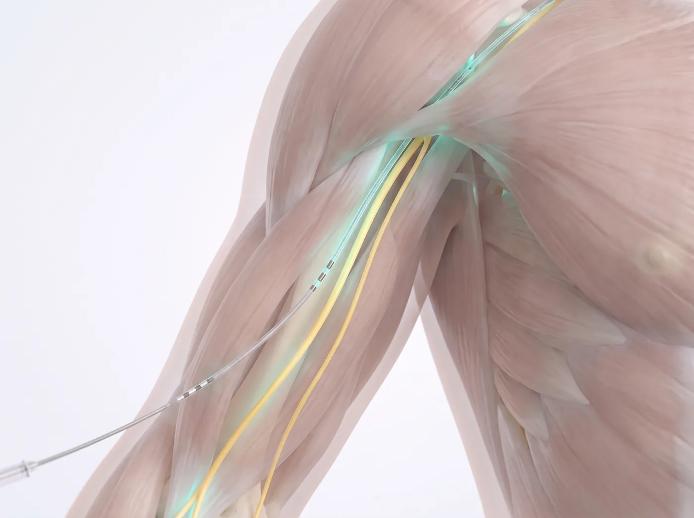 The lead — medical illustration