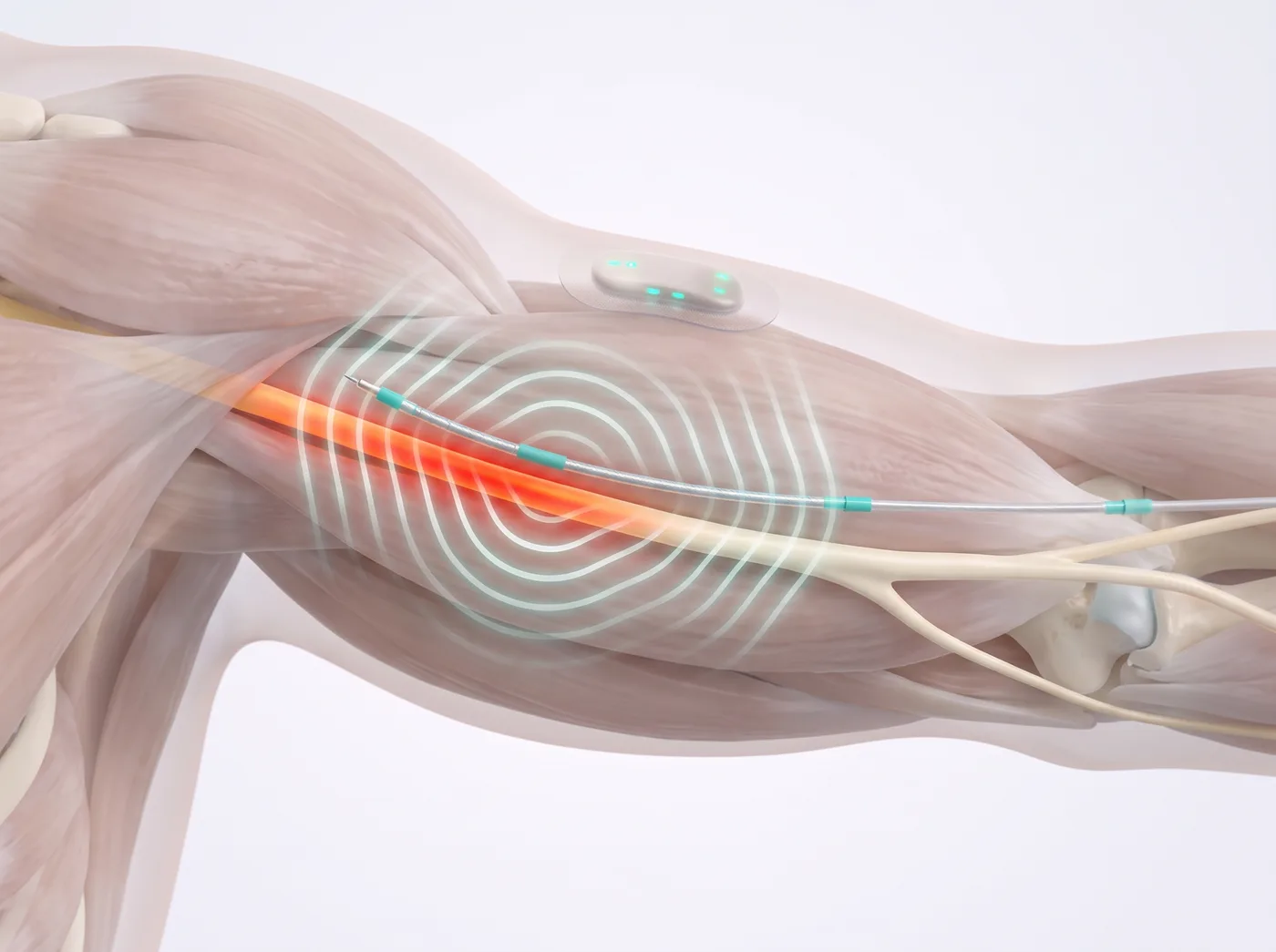 Masking the signal — medical illustration