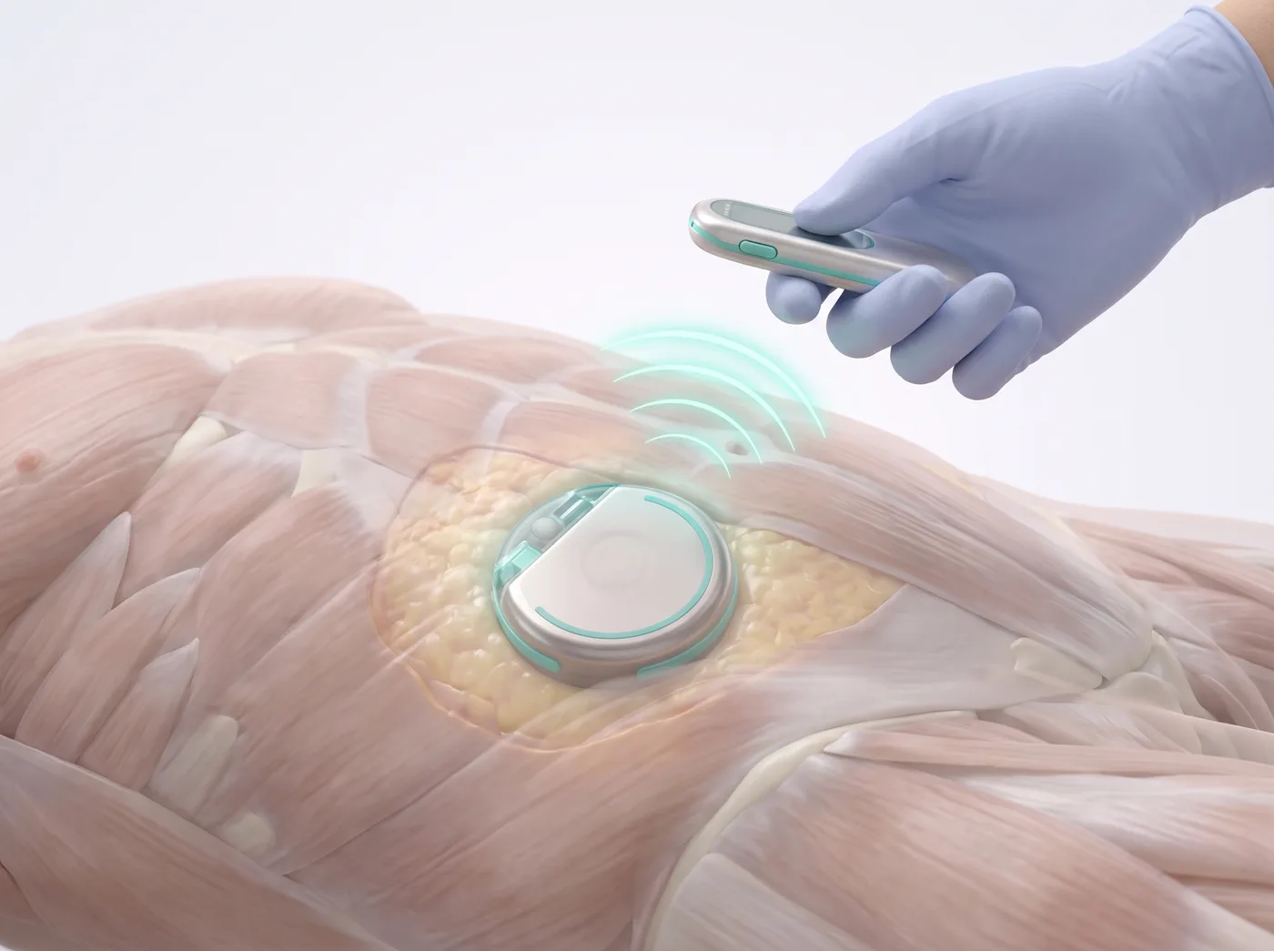 Living with it — medical illustration