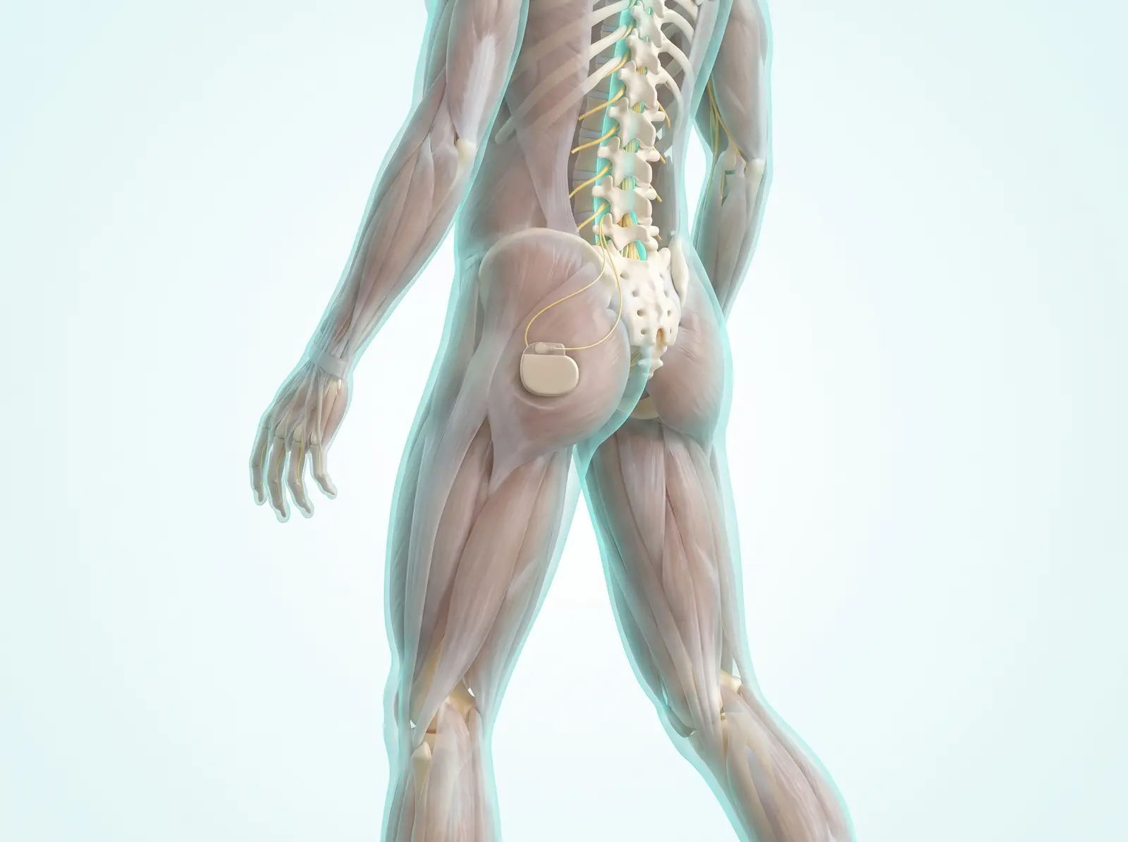 The implant — medical illustration