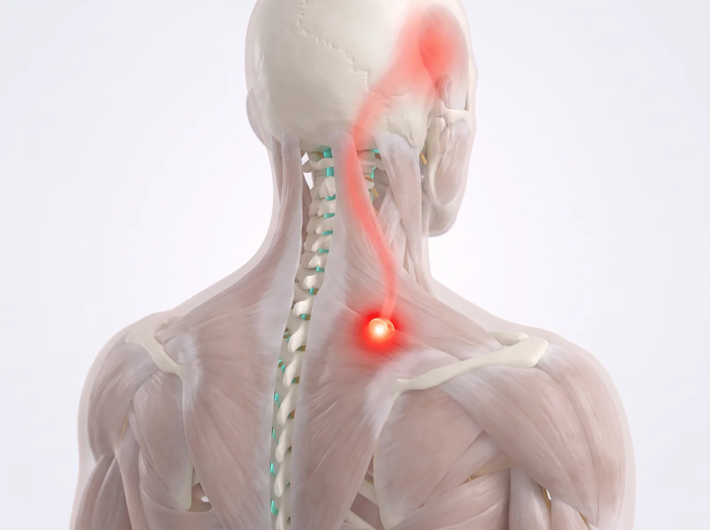 Referred pain — medical illustration