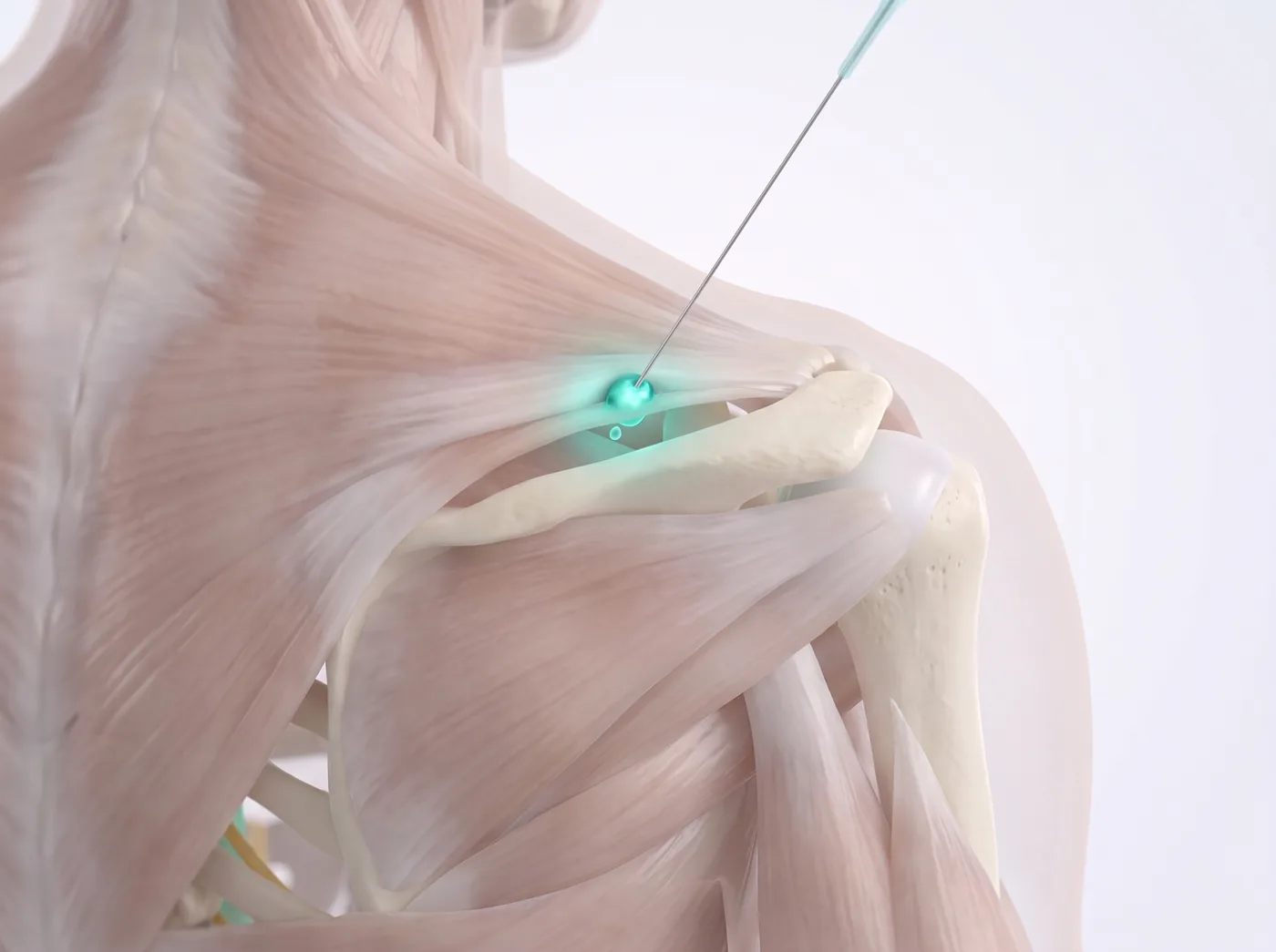 The release — medical illustration